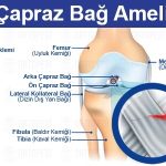 ön çapraz bağ ameliyatı