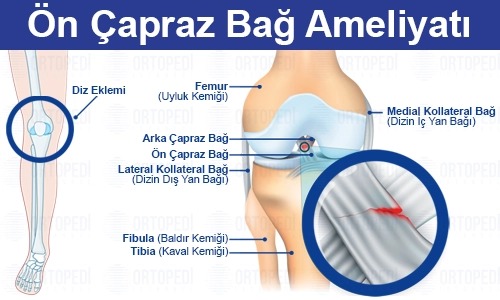 ön çapraz bağ ameliyatı